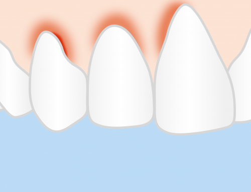 Gingivitis – What It Is and How You Can Avoid It