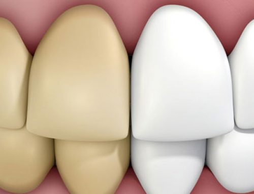 Cosmetic Dentist in Delta Address Teeth Discoloration
