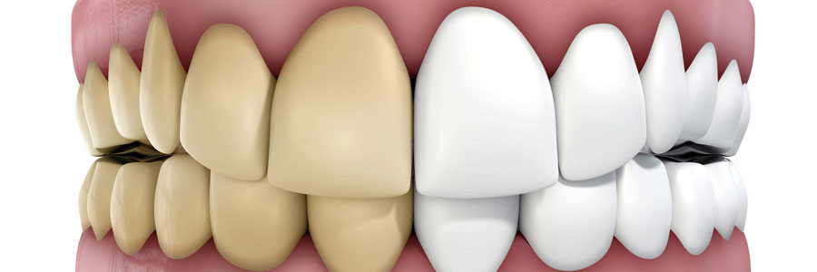 delta bc teeth discoloration
