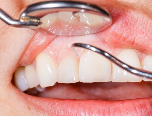 Receding Gums: Causes, Treatment, Surgery, and Prevention