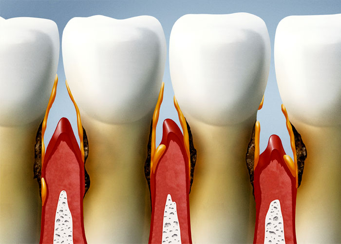 gum disease delta dentist