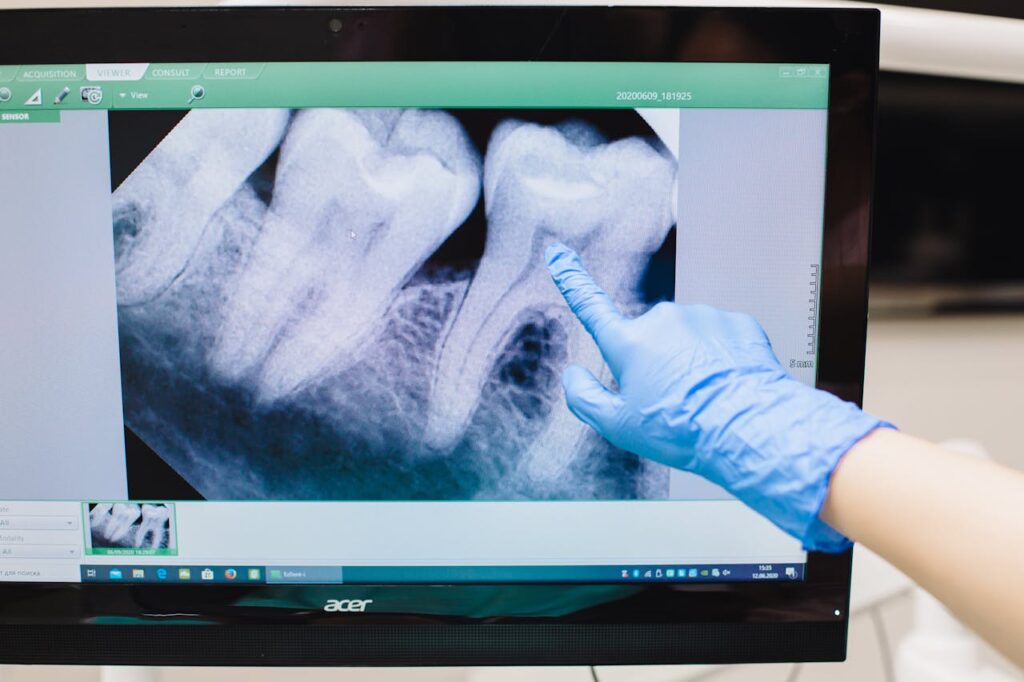 Close-up of a dental X-ray displayed on a monitor with a gloved hand pointing.